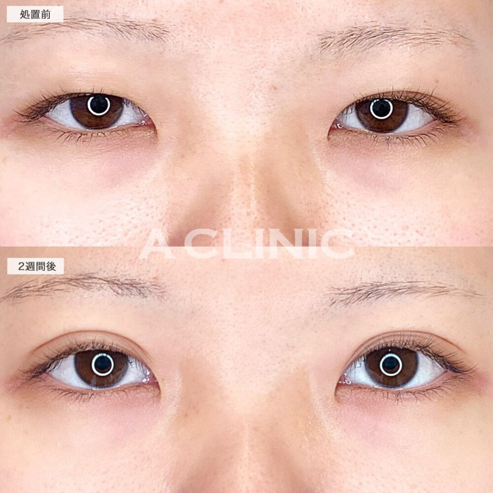 ディファインアイズでより目を大きく見せる！処置前と2週間後の症例です(20代女性)