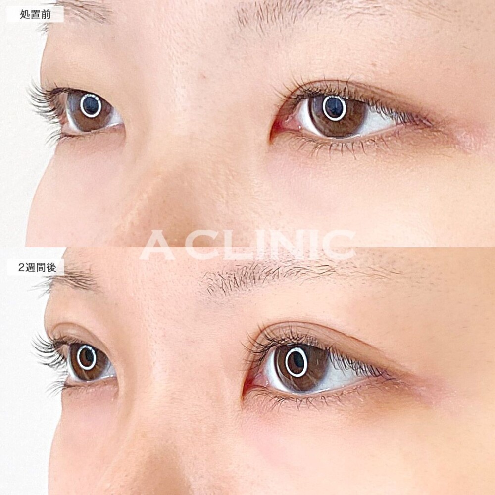 ディファインアイズでより目を大きく見せる！処置前と2週間後の症例です(20代女性)
