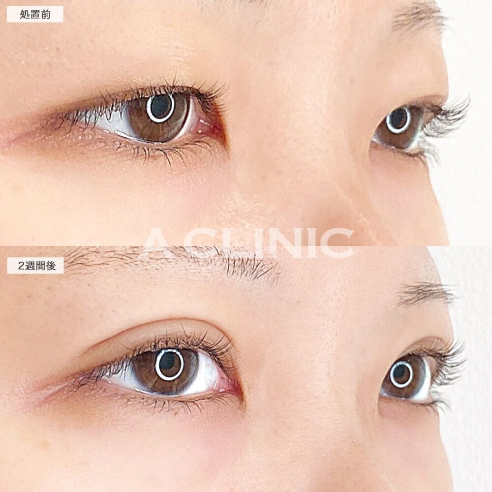 ディファインアイズでより目を大きく見せる！処置前と2週間後の症例です(20代女性)