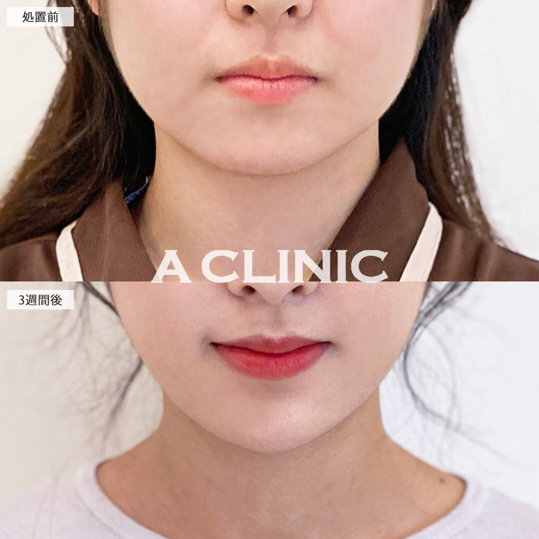 二重あごが解消して卵形の輪郭に！1day小顔脂肪吸引の処置前と3週間後の症例です(20代女性)