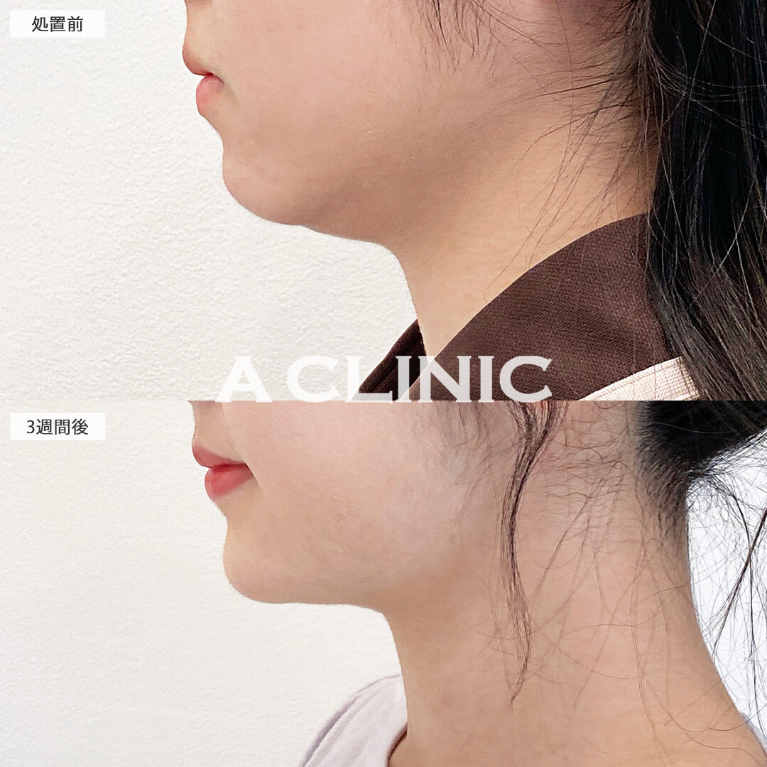 二重あごが解消して卵形の輪郭に！1day小顔脂肪吸引の処置前と3週間後の症例です(20代女性)