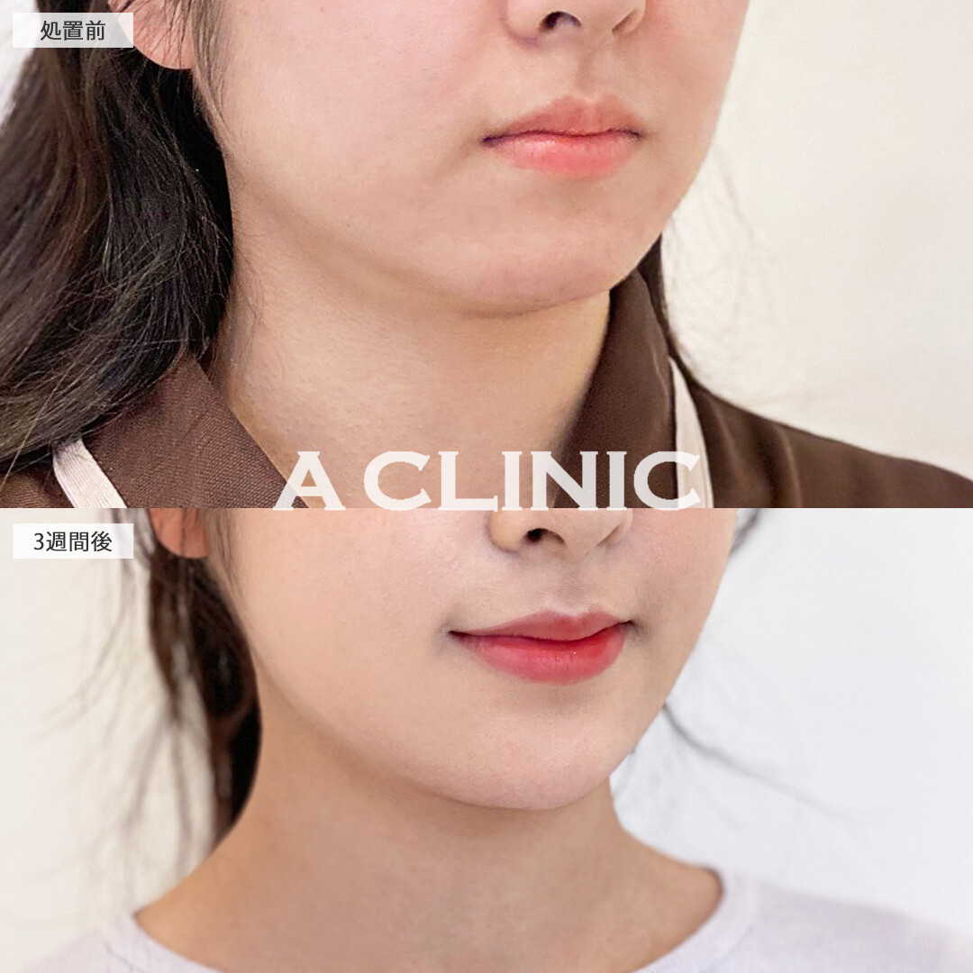 二重あごが解消して卵形の輪郭に！1day小顔脂肪吸引の処置前と3週間後の症例です(20代女性)