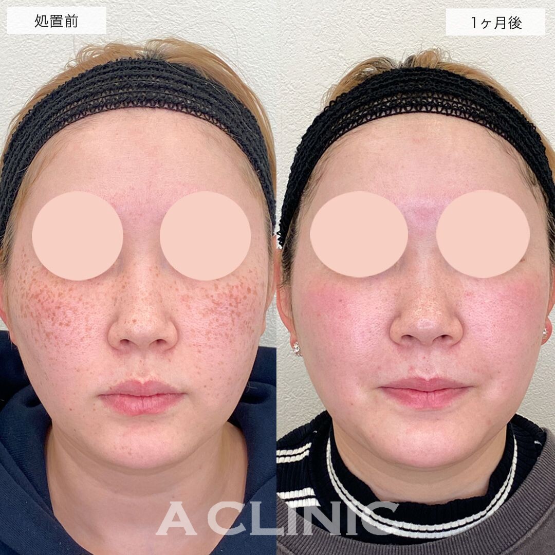 顔全体のシミやそばかすがピコスポットで綺麗に無くなりました♪こちら処置前と1ヶ月後の症例です(20代女性)
