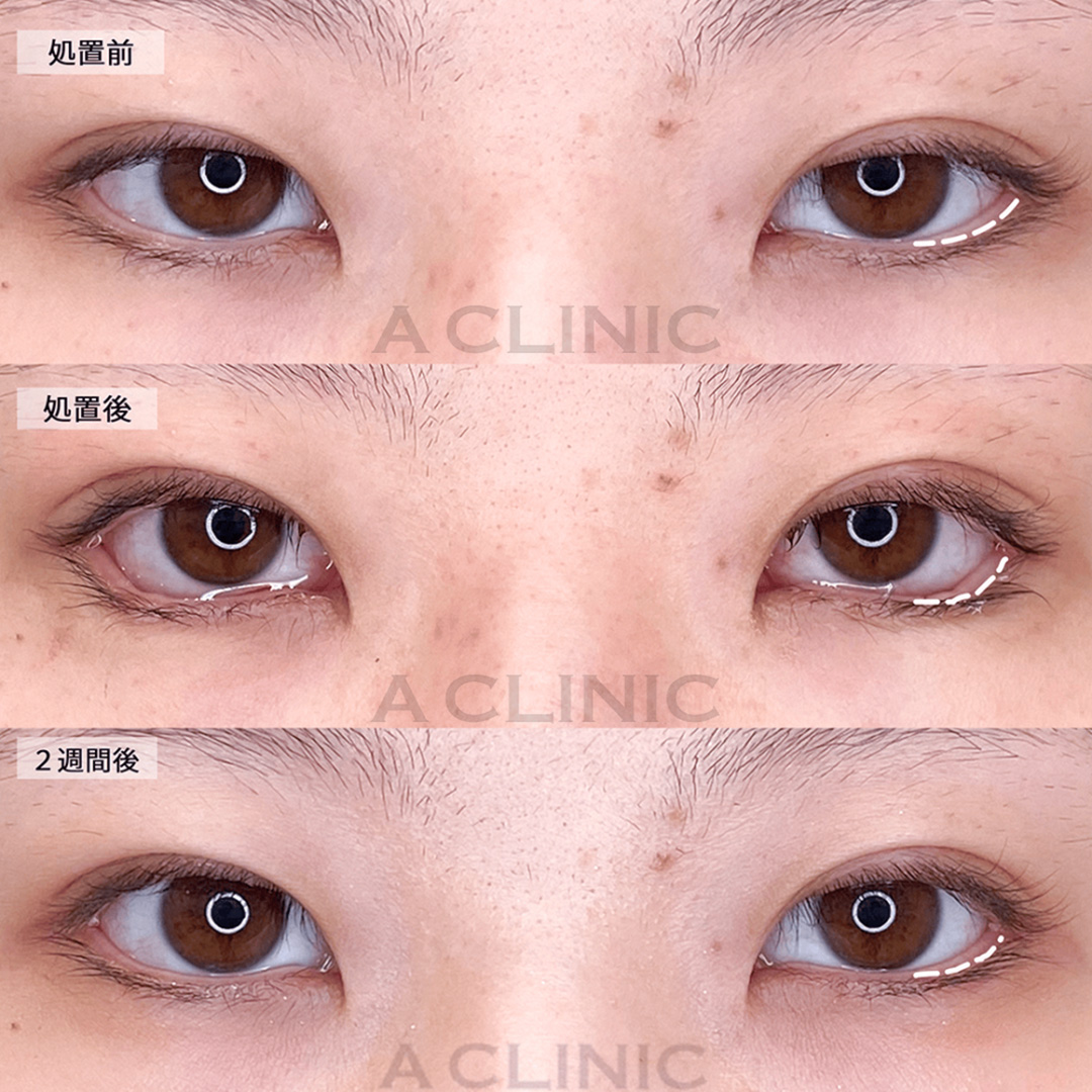 目元の印象もナチュラルに変化が出せます！パーフェクトアイズの処置前と直後と２週間後の症例です(20代女性)