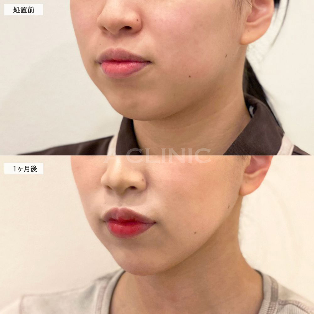 頬肉がスッキリしてキレイな輪郭に！1day小顔脂肪吸引の処置前と1ヶ月後の症例です(20代女性)