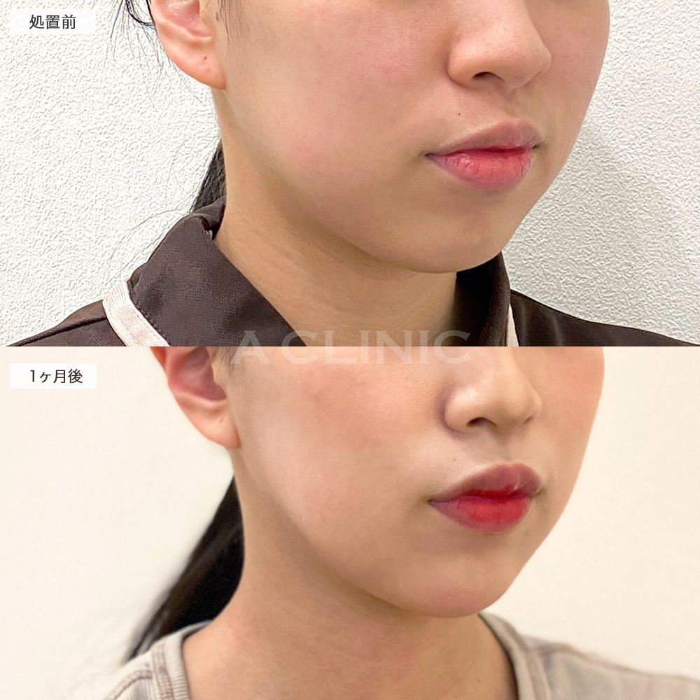 頬肉がスッキリしてキレイな輪郭に！1day小顔脂肪吸引の処置前と1ヶ月後の症例です(20代女性)