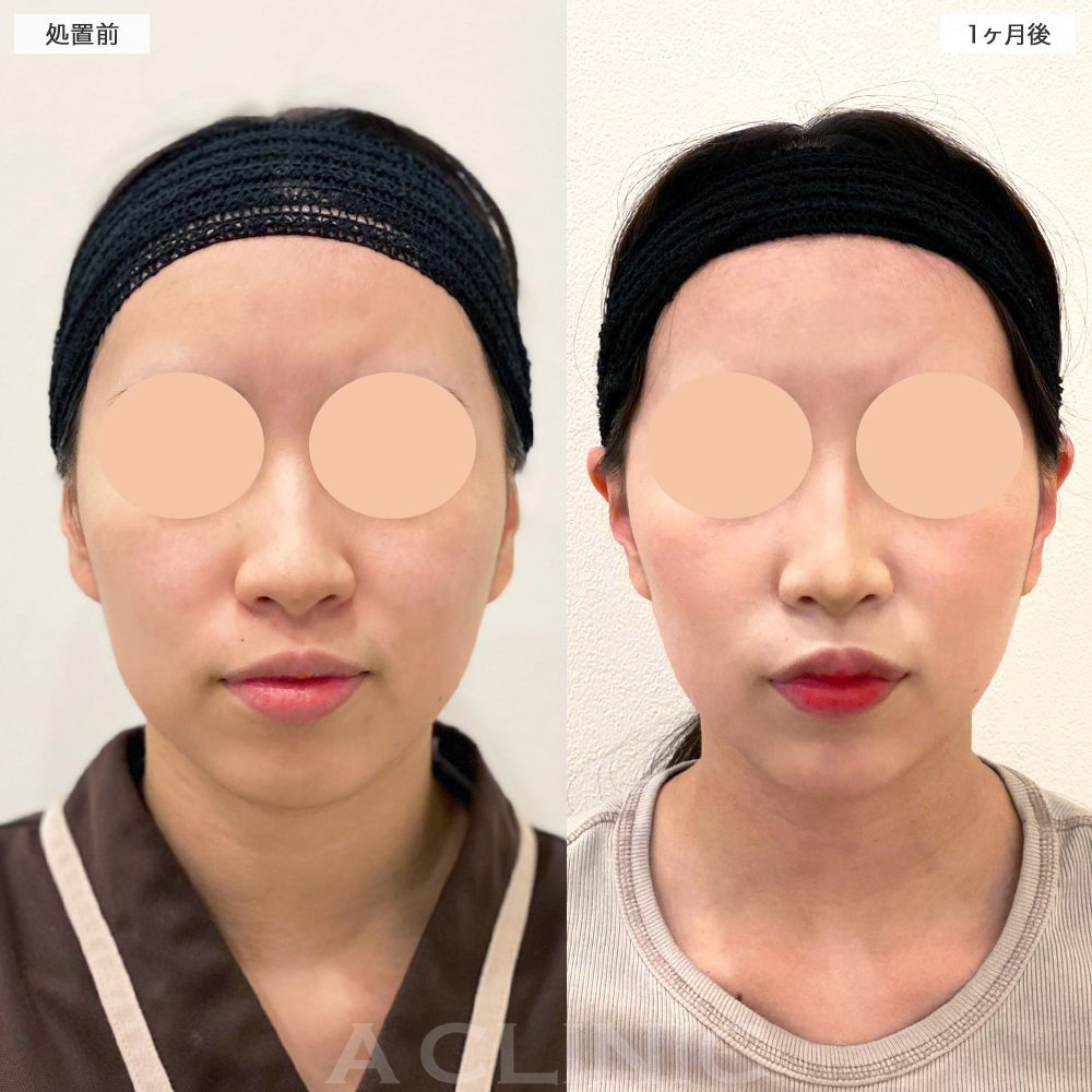 頬肉がスッキリしてキレイな輪郭に！1day小顔脂肪吸引の処置前と1ヶ月後の症例です(20代女性)
