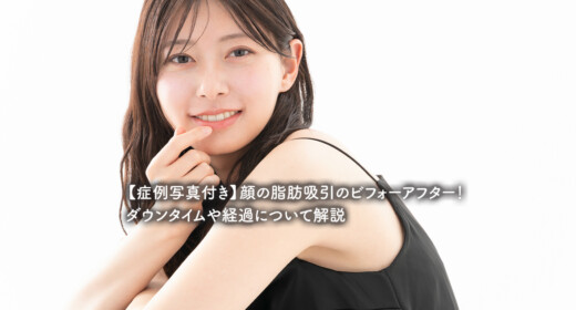 【症例写真付き】顔の脂肪吸引のビフォーアフター！ダウンタイムや経過について解説