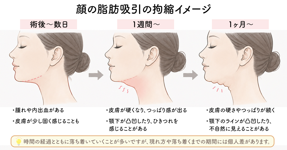 顔の脂肪吸引の拘縮