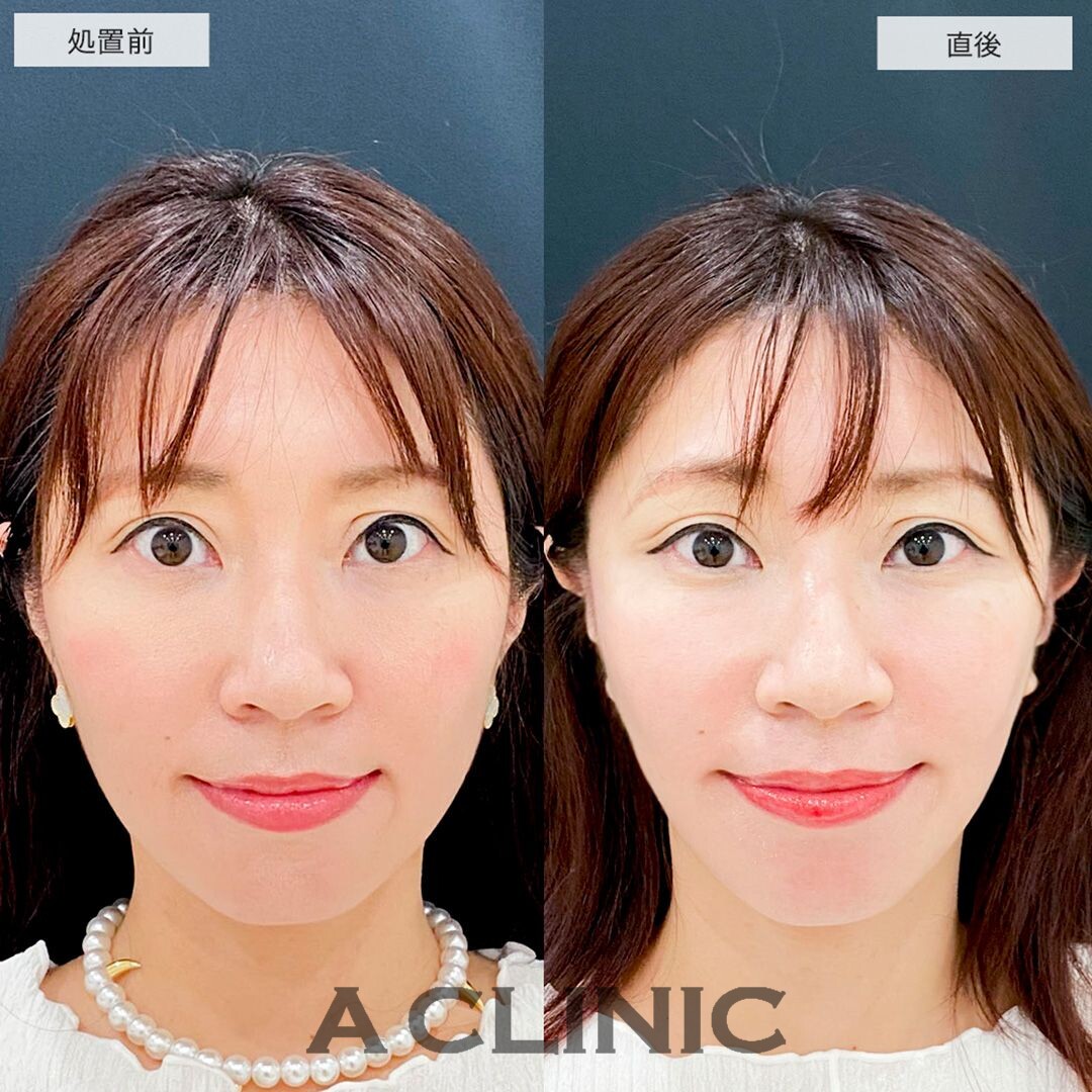 Aスレッドで直後からフェイスラインのもたつきがなくなりました！こちら処置前と直後の症例です(30代女性)