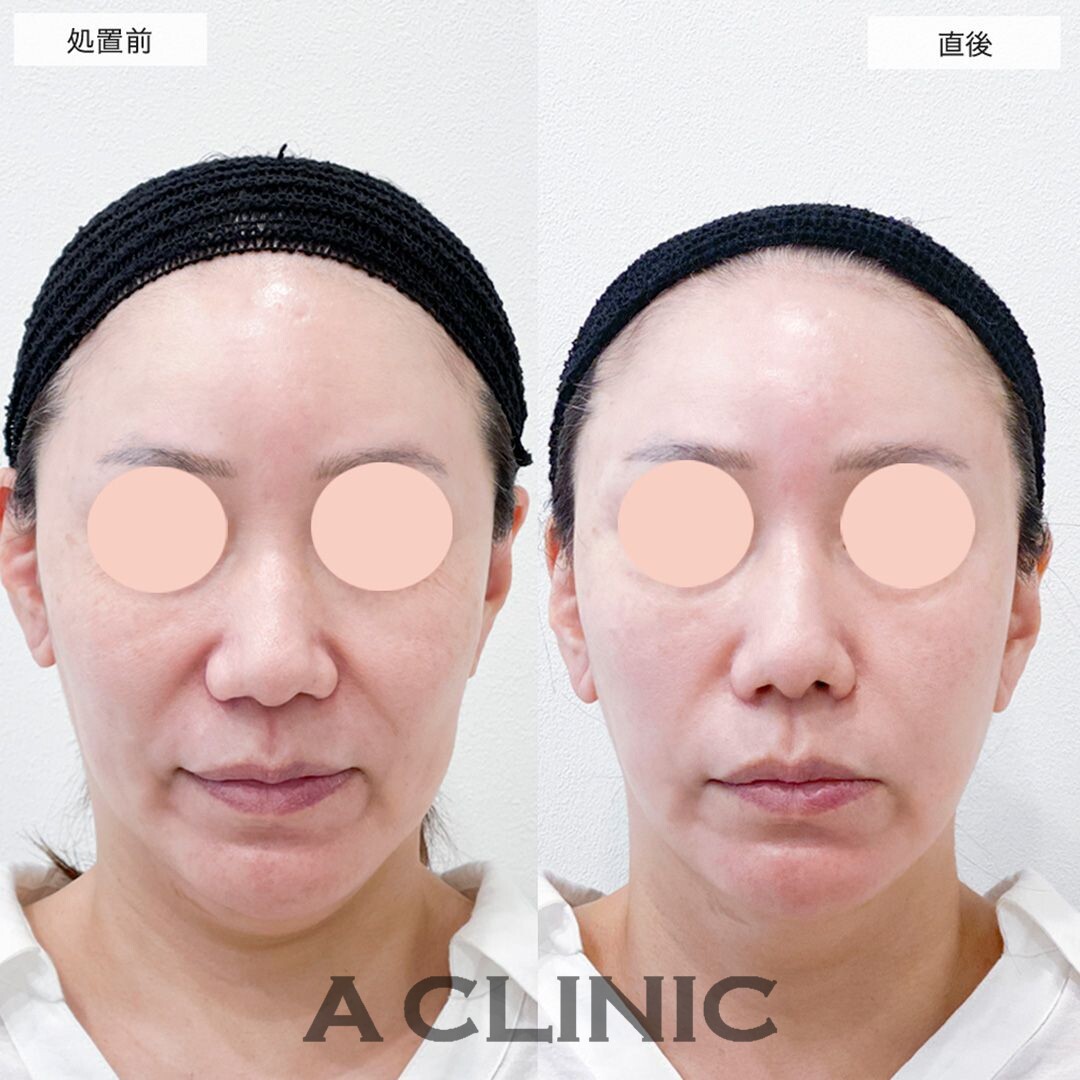 Aスレッドでゴルゴ線が薄くなりました！こちらは処置前と直後の症例です(40代女性)