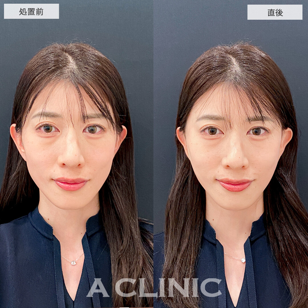 Aスレッドで輪郭のもたつきが解消されスッキリした輪郭に！こちら処置前と直後の症例です(40代女性)