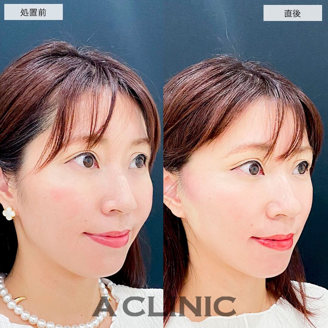 Aスレッドで直後からフェイスラインのもたつきがなくなりました！こちら処置前と直後の症例です(30代女性)