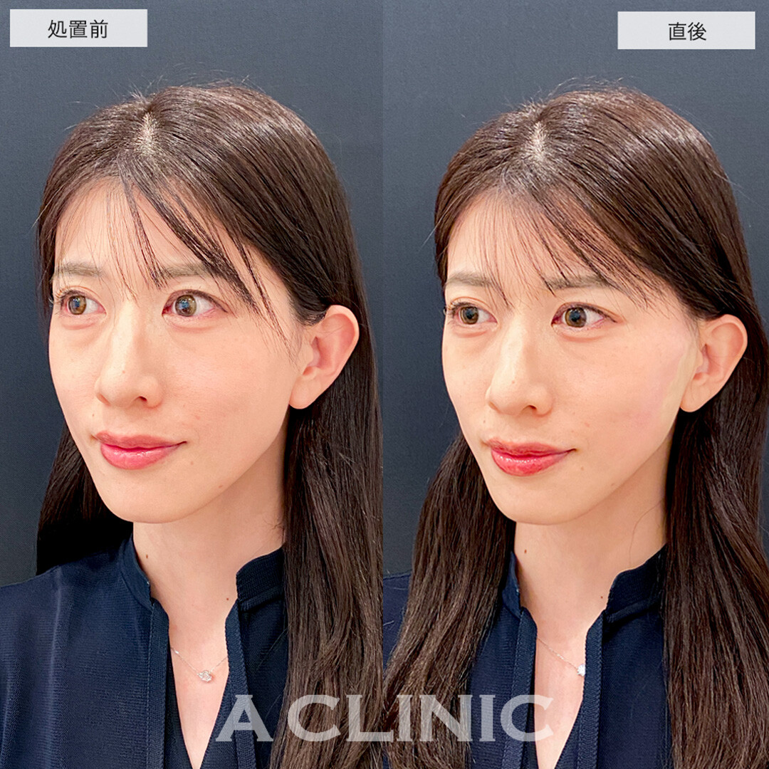 Aスレッドで輪郭のもたつきが解消されスッキリした輪郭に！こちら処置前と直後の症例です(40代女性)