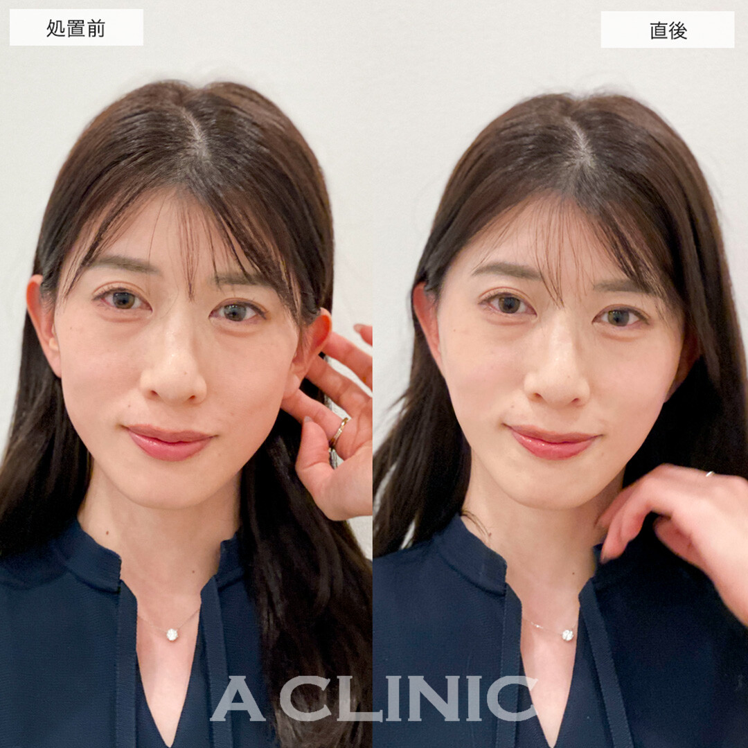 Aスレッドで輪郭のもたつきが解消されスッキリした輪郭に！こちら処置前と直後の症例です(40代女性)