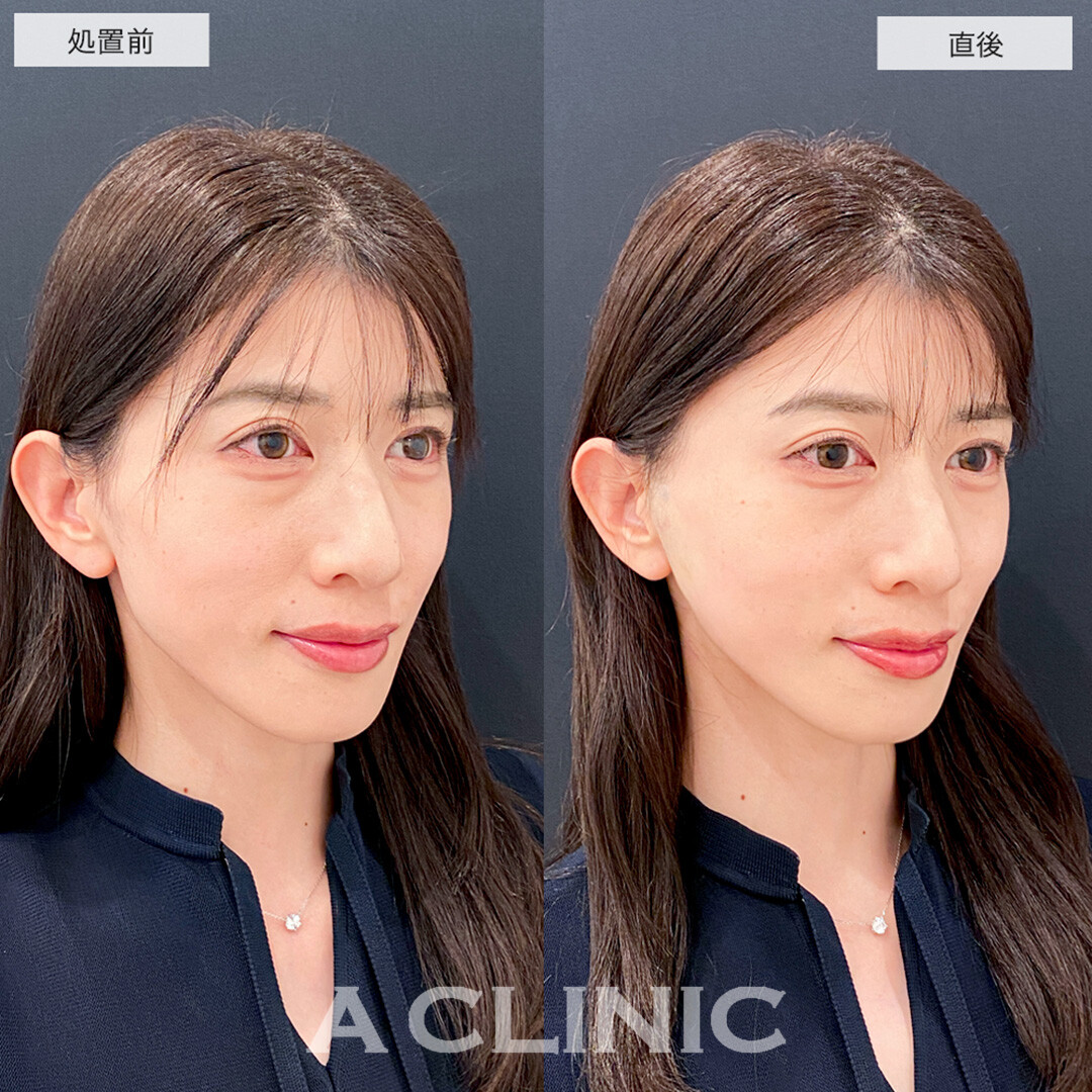 Aスレッドで輪郭のもたつきが解消されスッキリした輪郭に！こちら処置前と直後の症例です(40代女性)