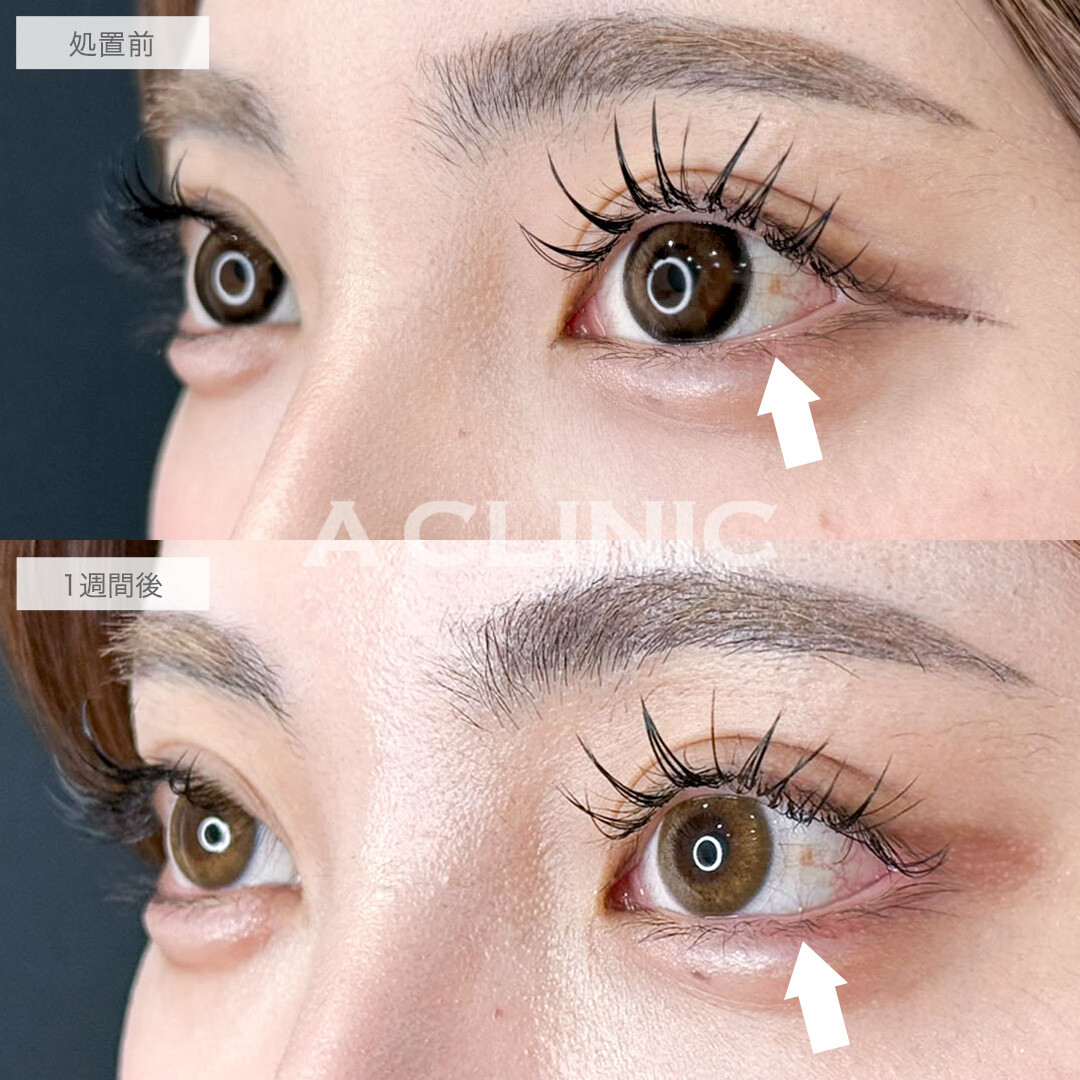 パーフェクトアイズで目尻を下げて優しく可愛いらしいお目元に!こちら処置前と1週間後の症例です(20代女性)