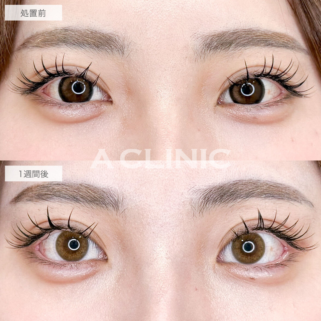 パーフェクトアイズで目尻を下げて優しく可愛いらしいお目元に!こちら処置前と1週間後の症例です(20代女性)