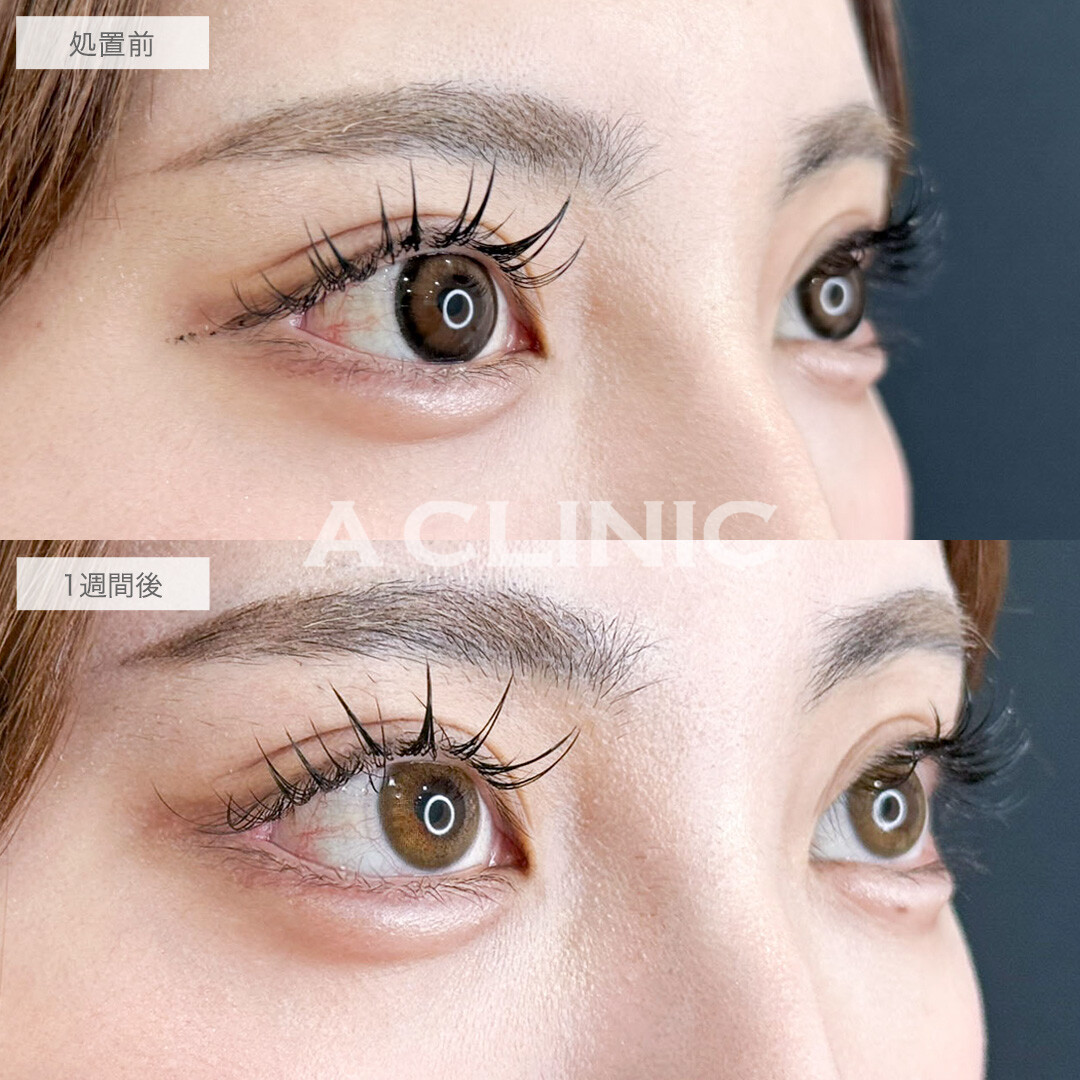 パーフェクトアイズで目尻を下げて優しく可愛いらしいお目元に!こちら処置前と1週間後の症例です(20代女性)