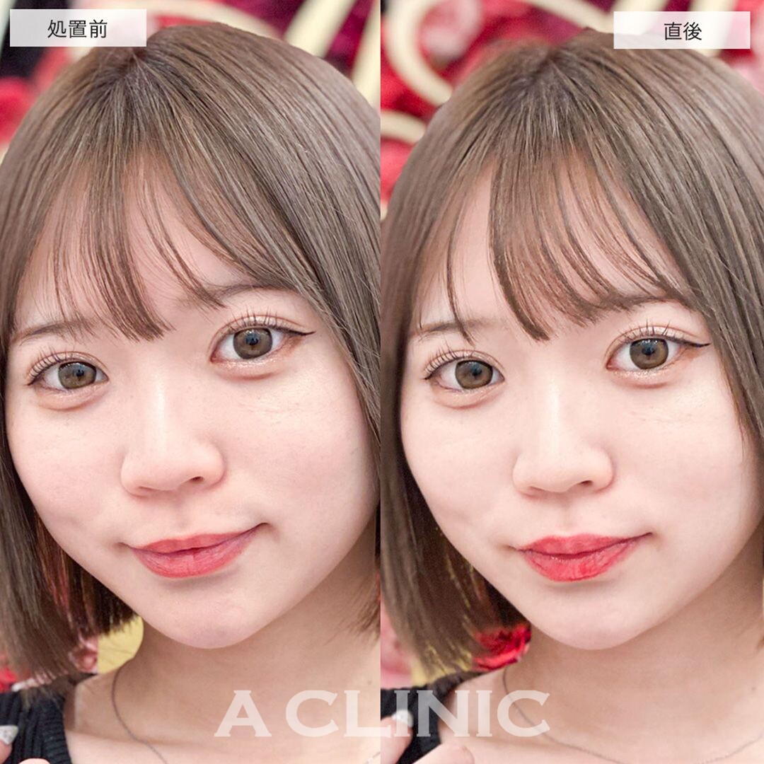 スマイルリップで人中が短くなりバブみ顔に！こちら処置前と直後の症例です(20代女性)