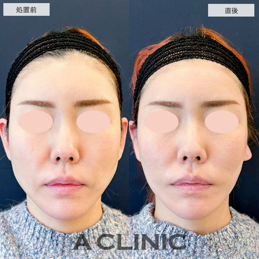 Aスレッドで輪郭周りのたるみを改善しました！こちら処置前と直後の症例です(30代女性)