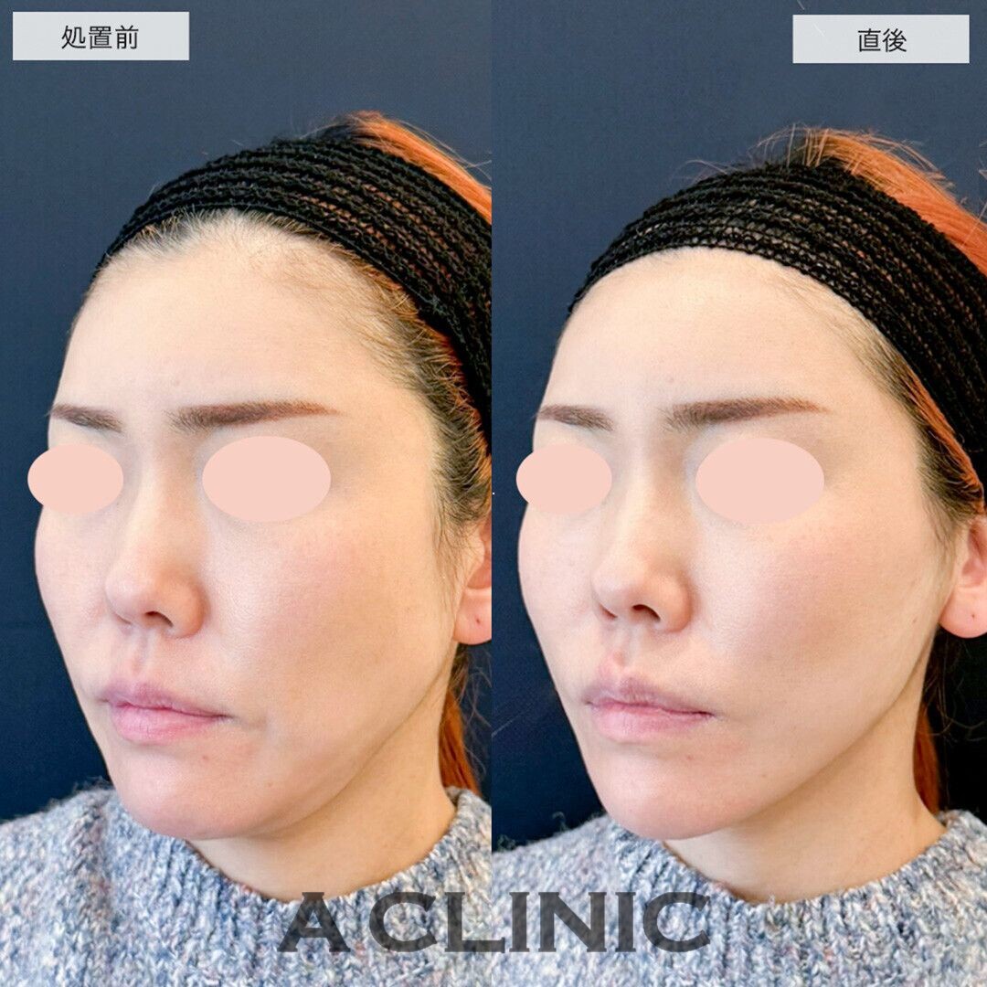 Aスレッドで輪郭周りのたるみを改善しました！こちら処置前と直後の症例です(30代女性)