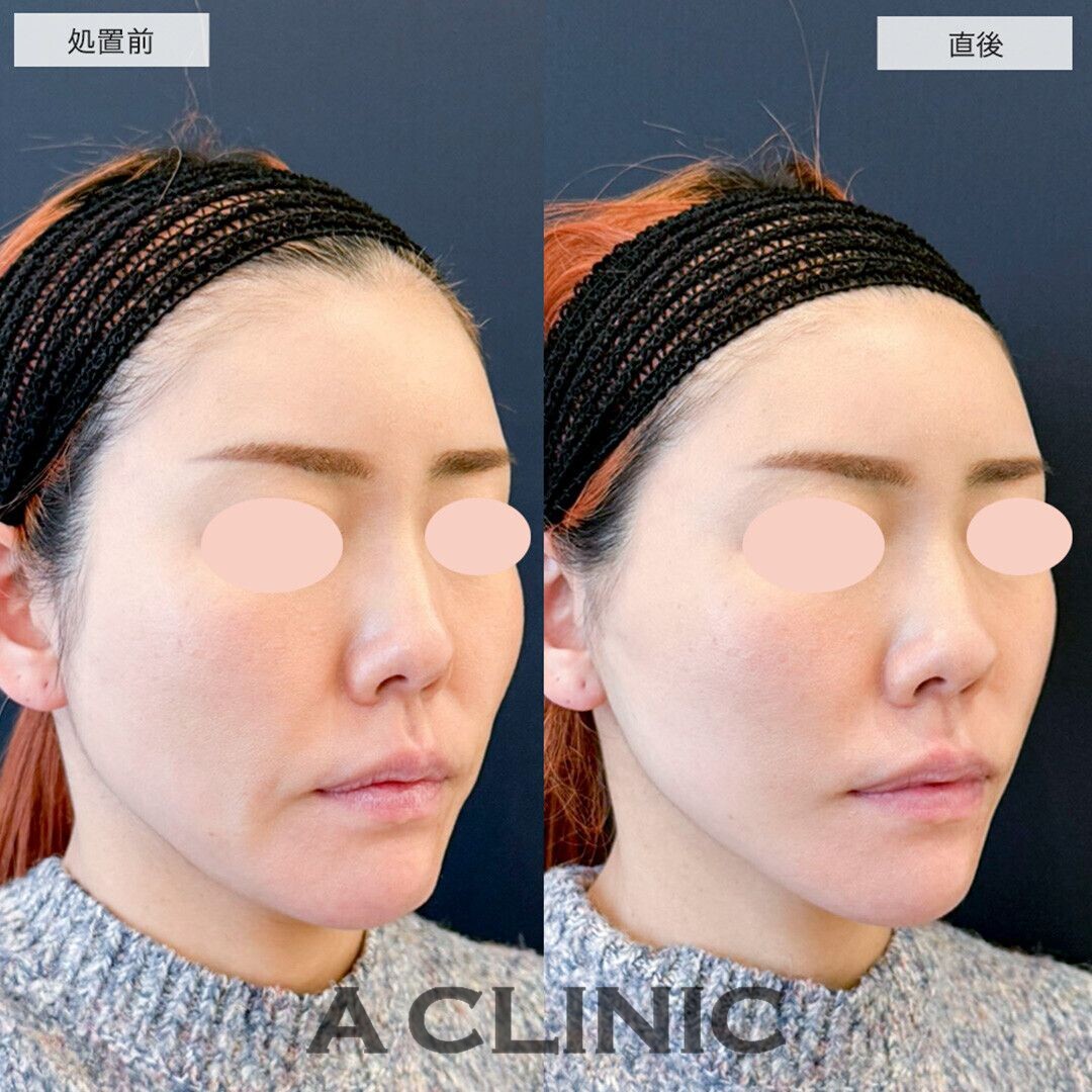 Aスレッドで輪郭周りのたるみを改善しました！こちら処置前と直後の症例です(30代女性)