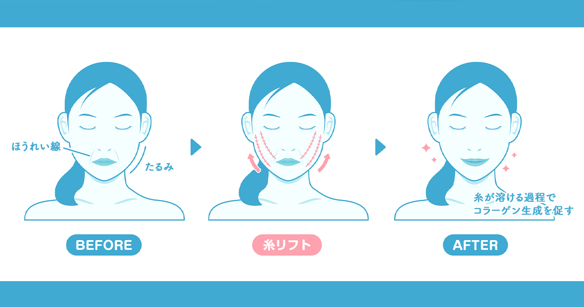 糸リフトの仕組み