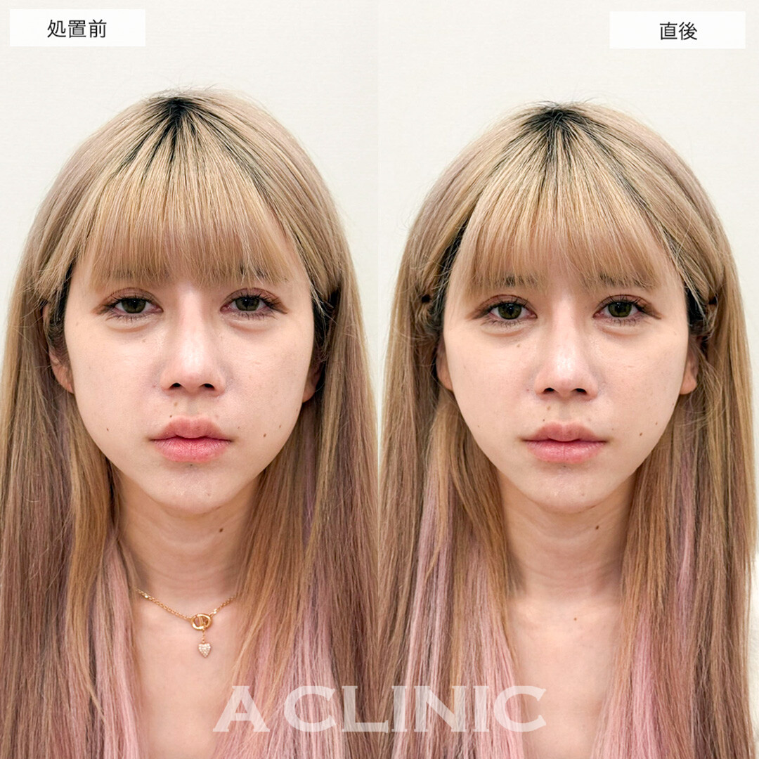 輪郭の左右差がAスレッドで即日綺麗に整いました!こちら処置前と直後の症例です(30代女性)