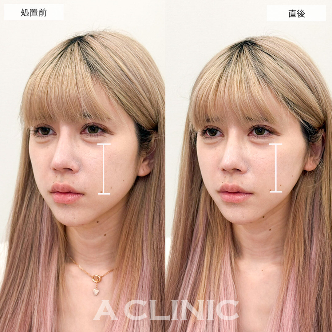 輪郭の左右差がAスレッドで即日綺麗に整いました!こちら処置前と直後の症例です(30代女性)