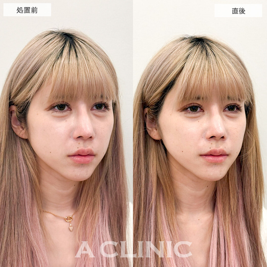 輪郭の左右差がAスレッドで即日綺麗に整いました!こちら処置前と直後の症例です(30代女性)