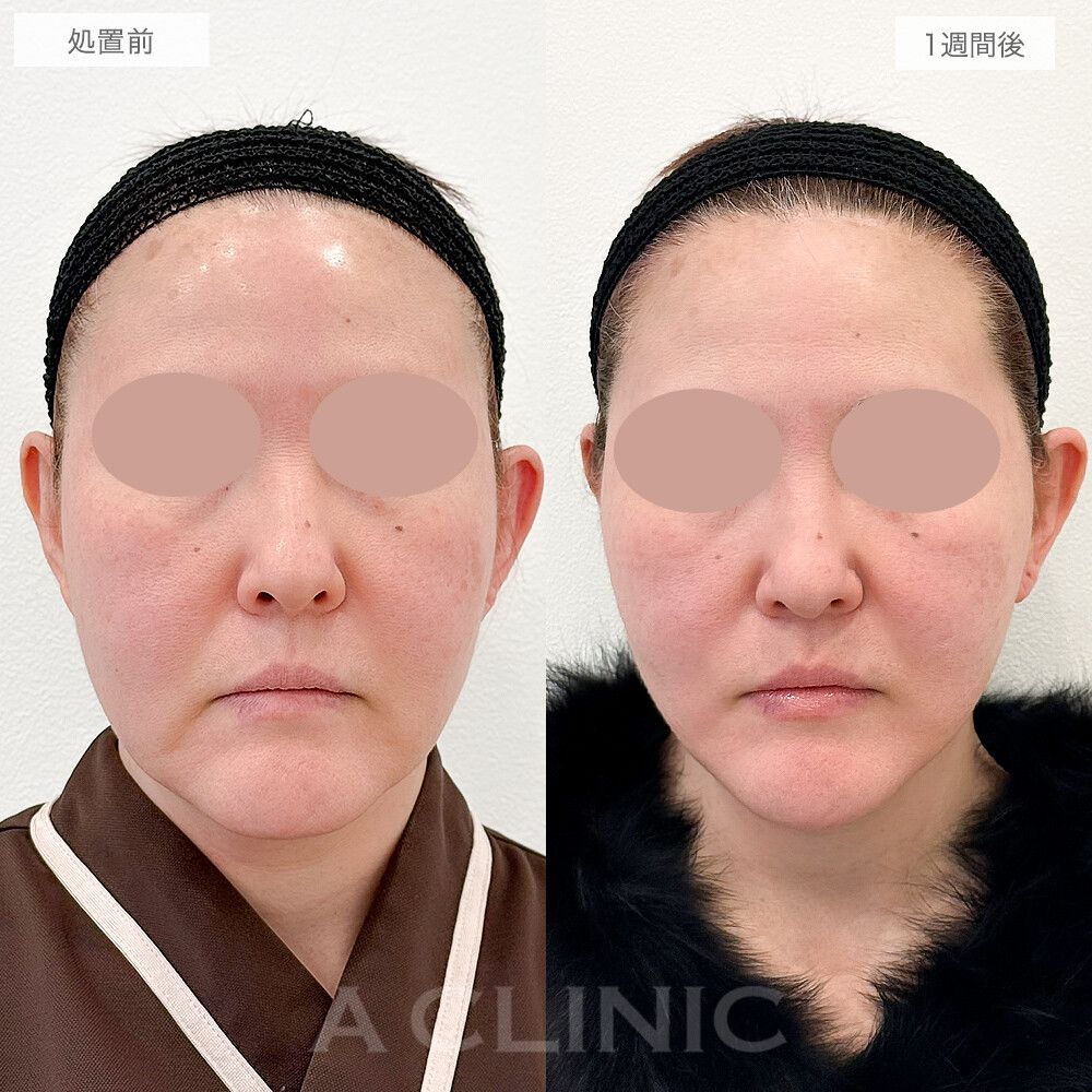 フェイスラインが引き上がり小顔効果も！A式美肌たるみ切開の処置前と1週間後の症例です(50代女性)