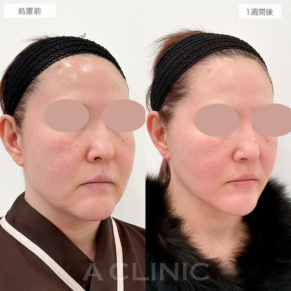 フェイスラインが引き上がり小顔効果も！A式美肌たるみ切開の処置前と1週間後の症例です(50代女性)