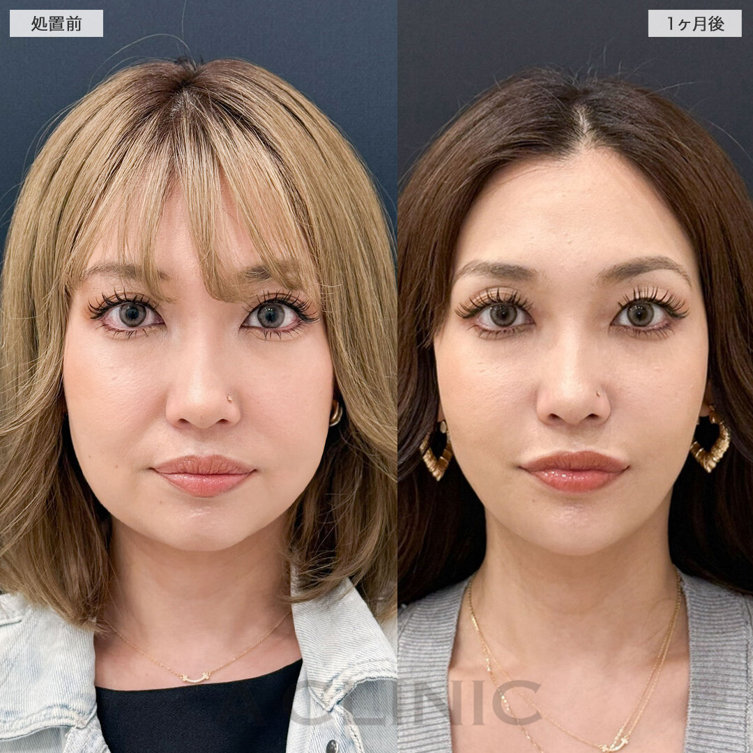 ダウンタイム最小限で圧倒的小顔に！こちら1day小顔脂肪吸引と小顔エラボトックスの処置前と1ヶ月後の症例です(30代女性)