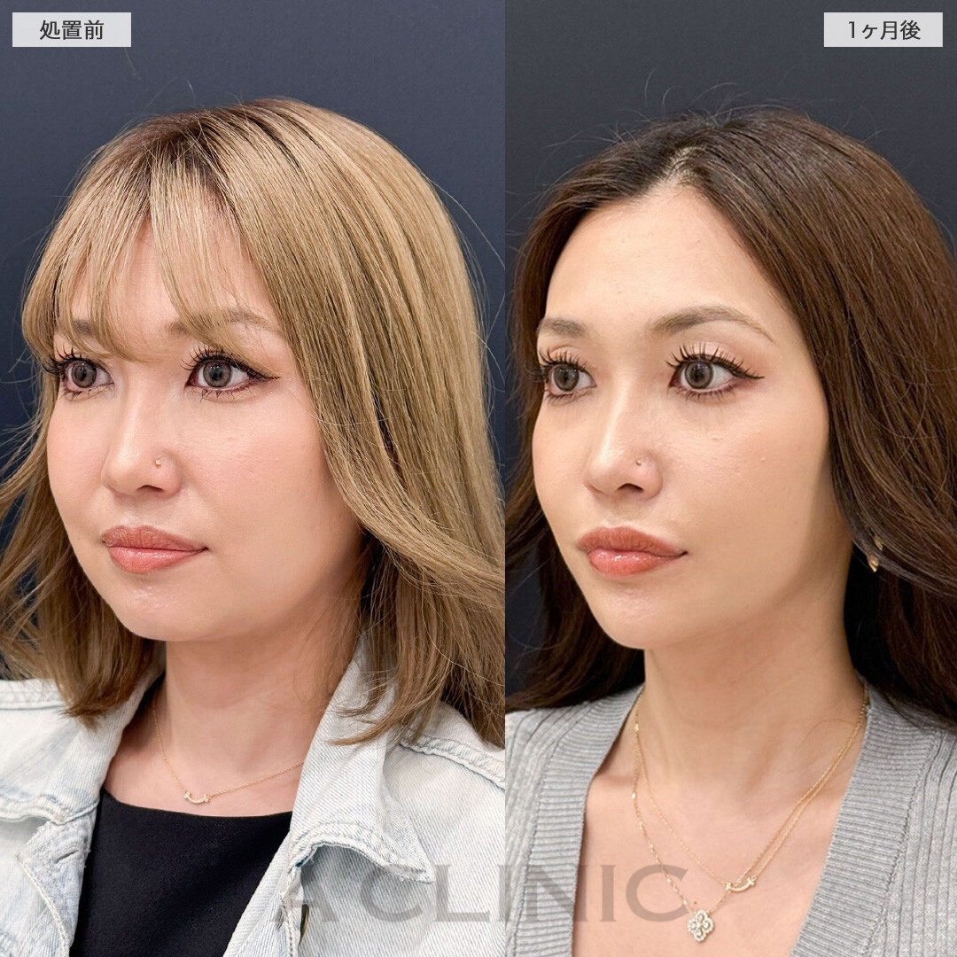 ダウンタイム最小限で圧倒的小顔に！こちら1day小顔脂肪吸引と小顔エラボトックスの処置前と1ヶ月後の症例です(30代女性)