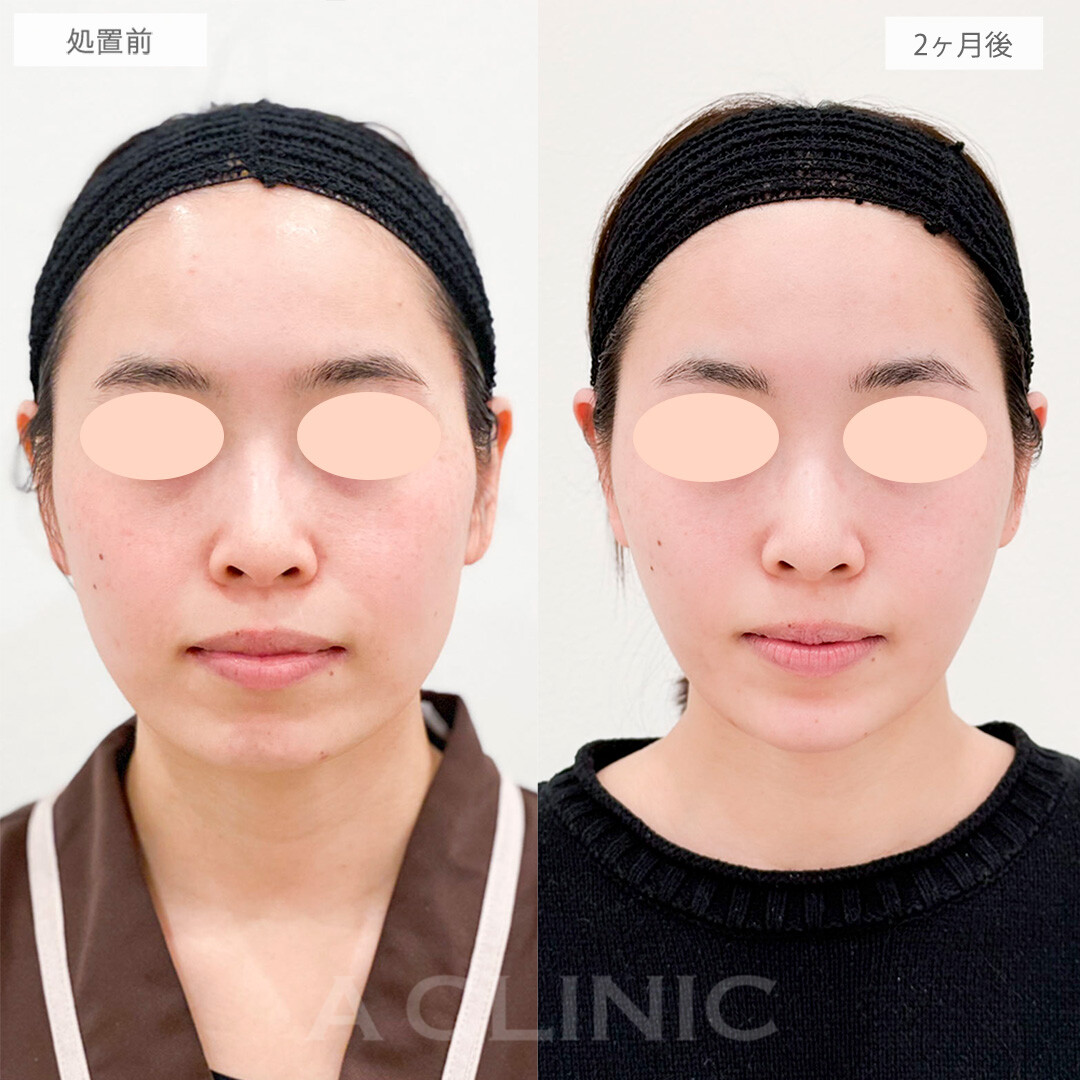 1day小顔脂肪吸引とエラボトックスとヒアル注入で別人級の輪郭に！処置前と2ヶ月後の症例です(20代女性)