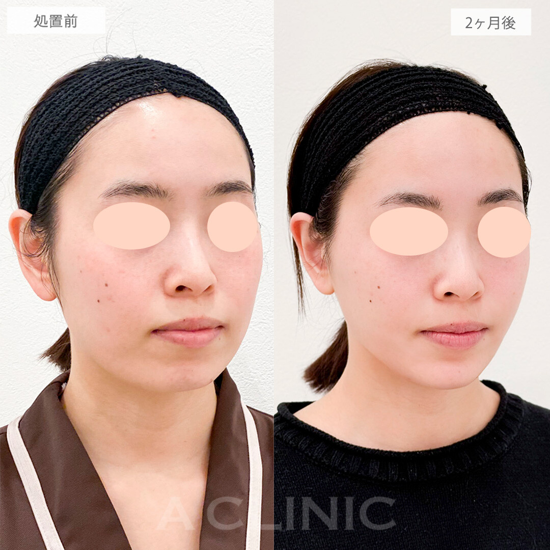 1day小顔脂肪吸引とエラボトックスとヒアル注入で別人級の輪郭に！処置前と2ヶ月後の症例です(20代女性)