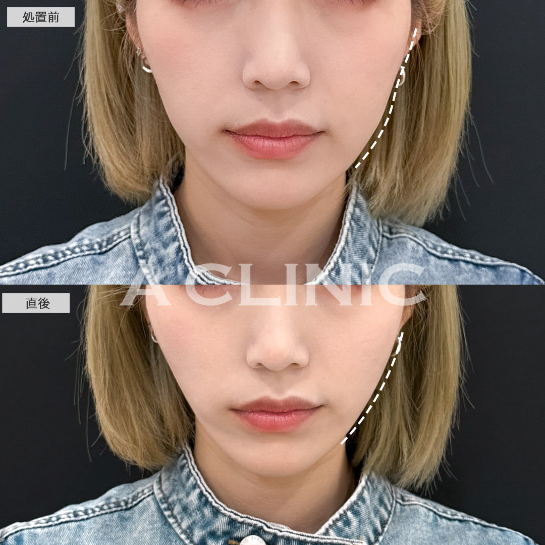 口横のたるみも目立ちにくくなりました！こちらAスレッドの処置前と直後の症例です(30代女性)