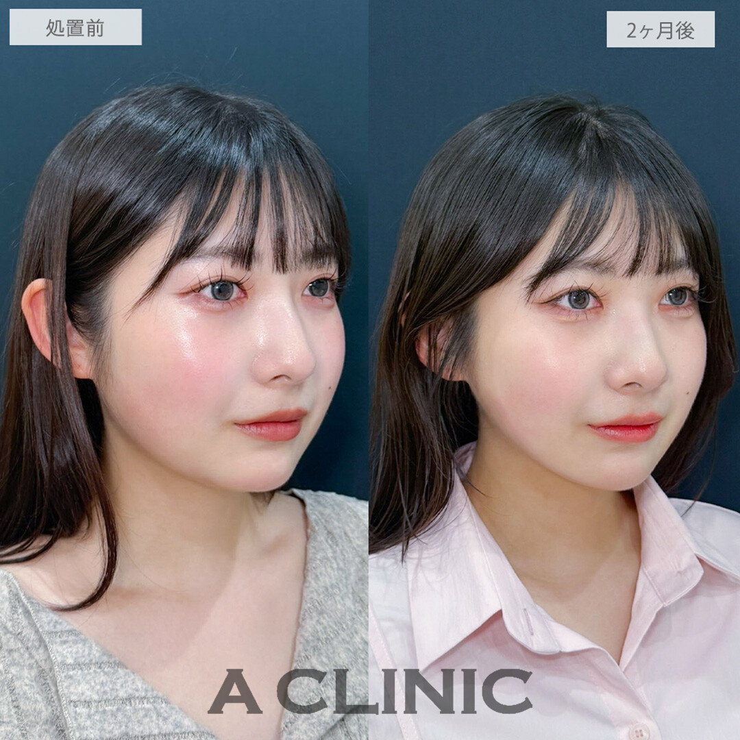 1day小顔脂肪吸引で綺麗な卵型フェイスの輪郭美人誕生しました！処置前から2ヶ月後の症例です(20代女性)