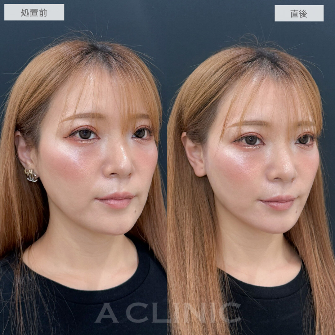 リフトアップ＆美肌効果で若々しさをキープ！こちらAスレッドの処置前と直後の症例です(30代女性)