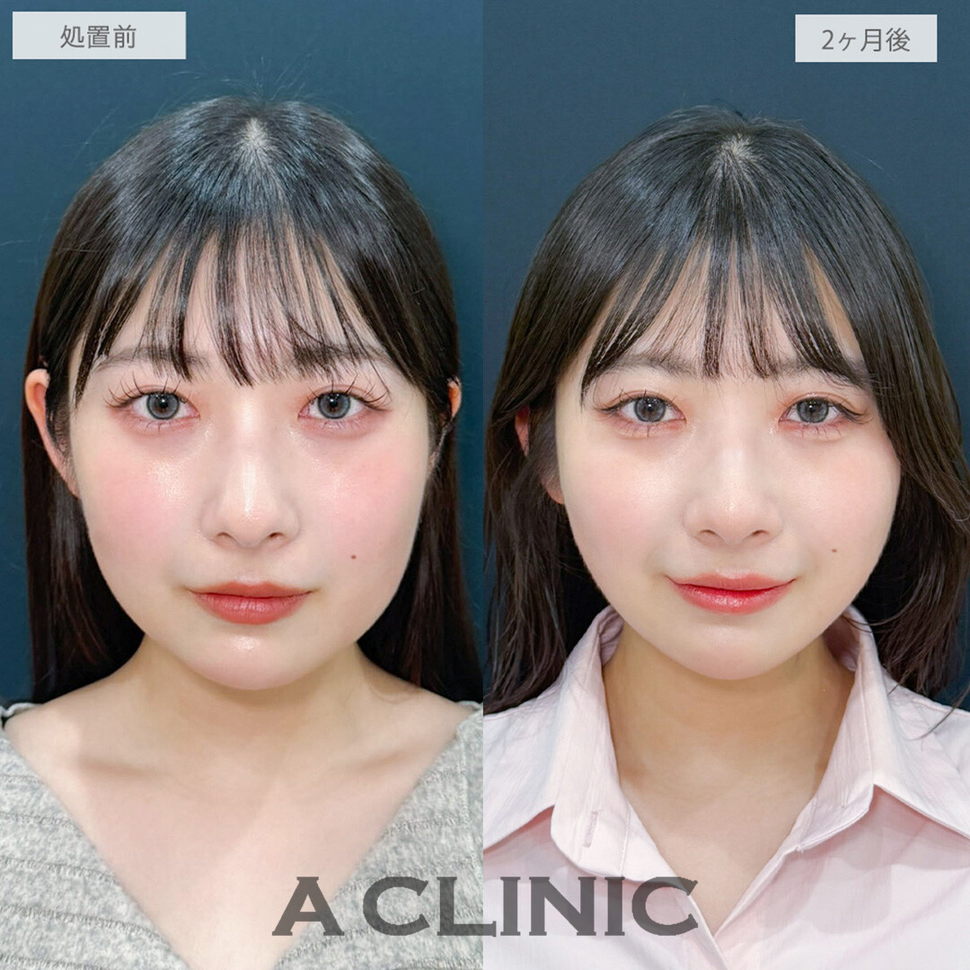 1day小顔脂肪吸引で綺麗な卵型フェイスの輪郭美人誕生しました！処置前から2ヶ月後の症例です(20代女性)