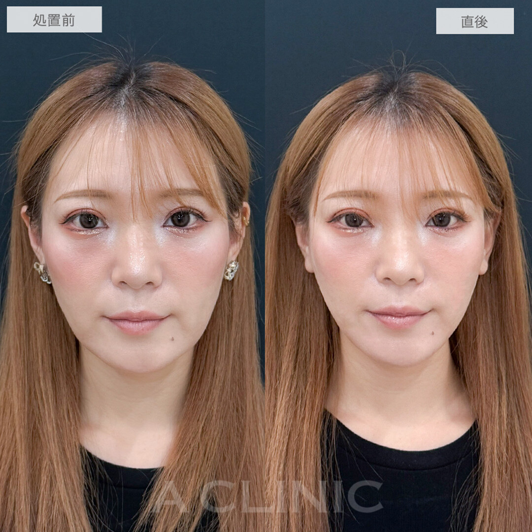 リフトアップ＆美肌効果で若々しさをキープ！こちらAスレッドの処置前と直後の症例です(30代女性)