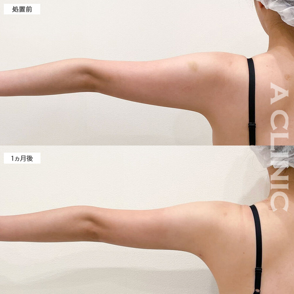 二の腕スリム脂肪吸引で気になる振袖部分の脂肪がスッキリと変化しました！こちら処置前と1ヶ月後の症例です(30代女性)