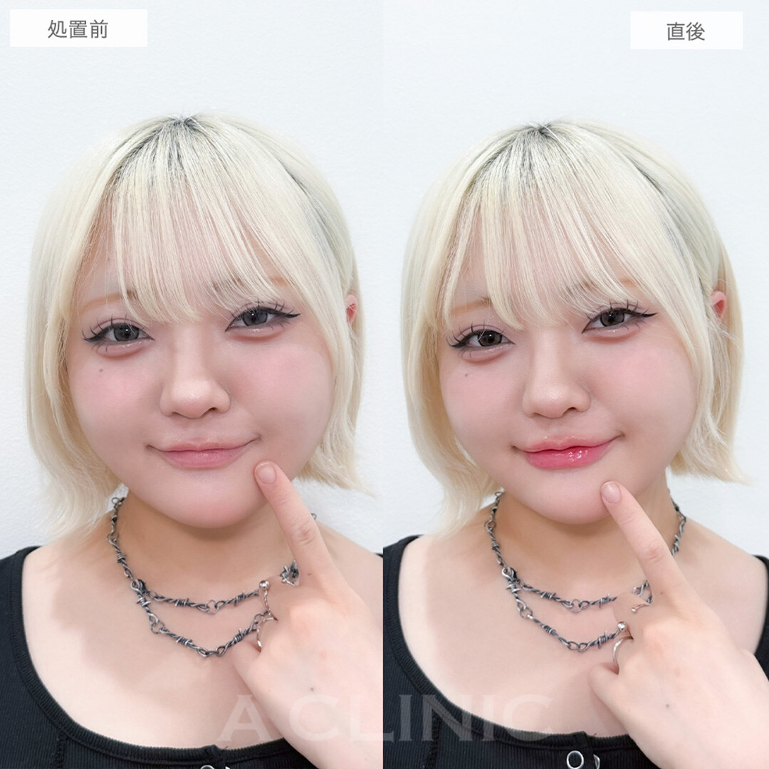 スマイルリップでバブみが増した可愛い口元に！処置前と直後の症例です(20代女性)