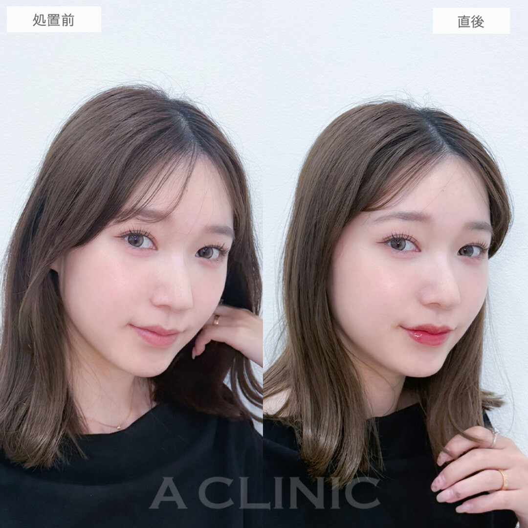 スマイルリップで左右差のない理想の唇に！処置前と直後の症例です(20代女性)