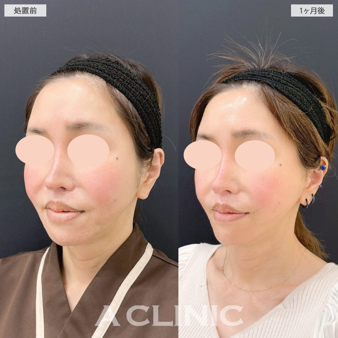 【直後の傷跡あり】A式美肌たるみ切開でたるみ改善と小顔が同時に叶う！処置前と1ヶ月後の症例です(50代女性)