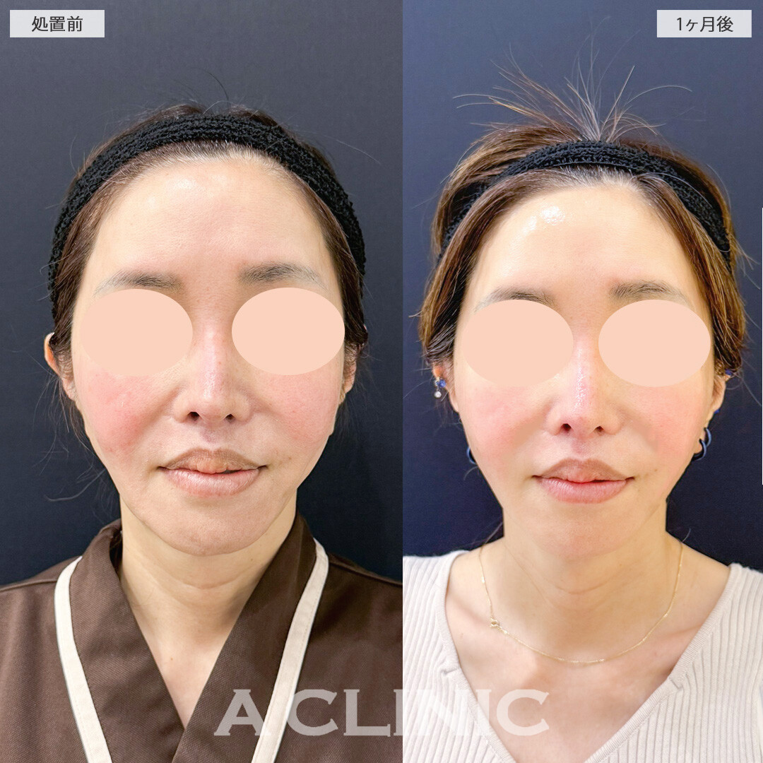 【直後の傷跡あり】A式美肌たるみ切開でたるみ改善と小顔が同時に叶う！処置前と1ヶ月後の症例です(50代女性)
