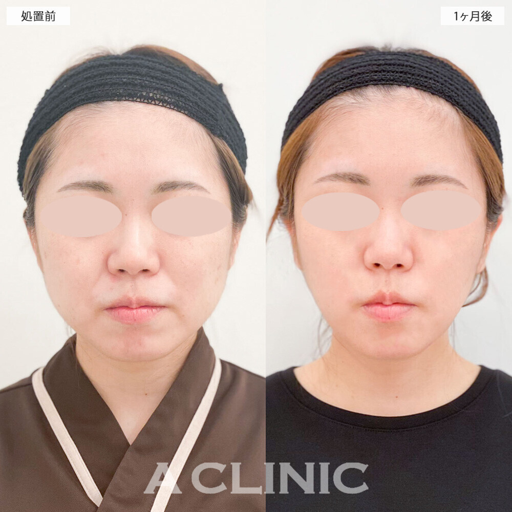 1day小顔脂肪吸引でフェイスラインのもたつきがスッキリしました！こちら処置前から2ヶ月後の症例です。(30代女性)