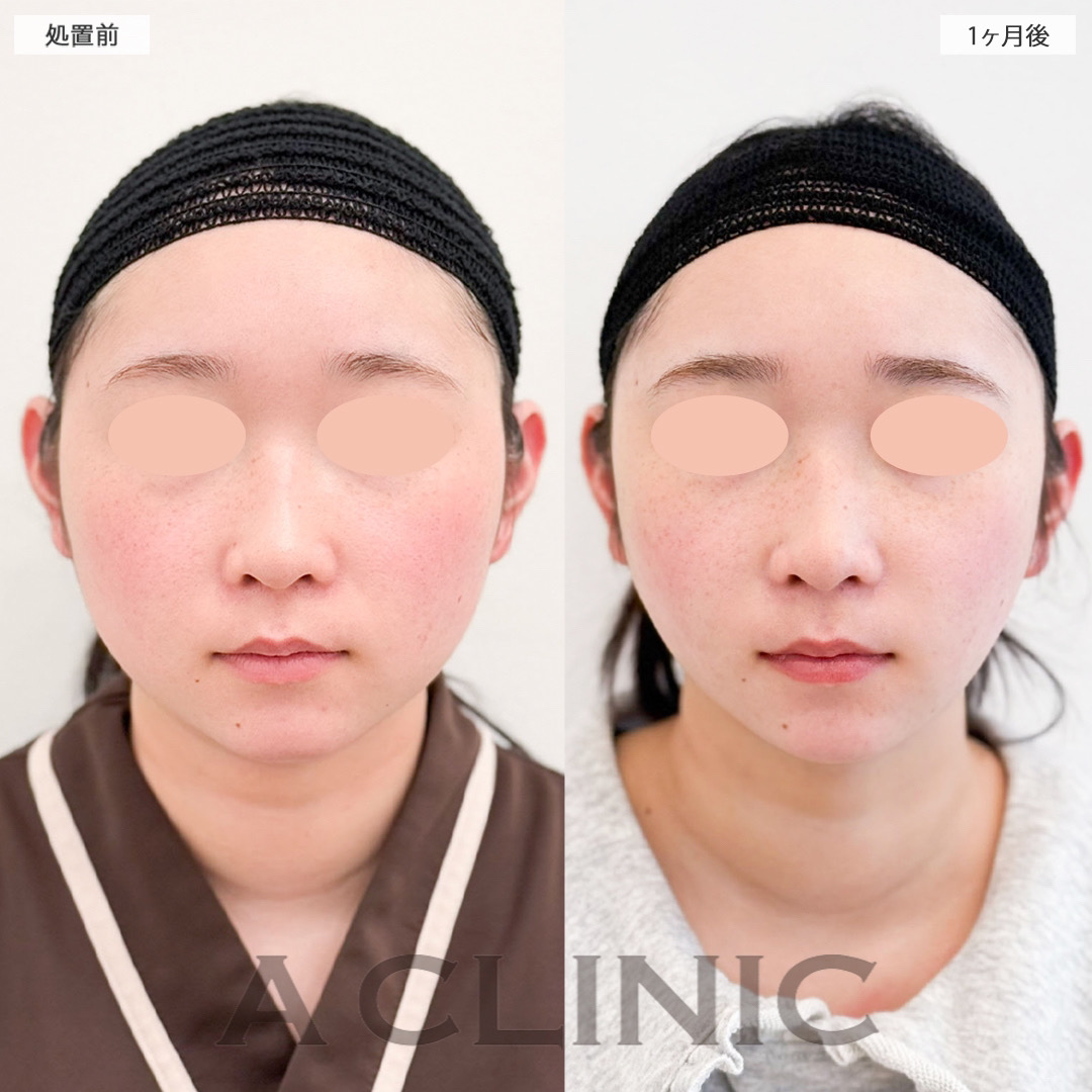 1day小顔脂肪吸引で輪郭がハッキリしました！こちら処置前と1ヶ月後の症例です(20代女性)