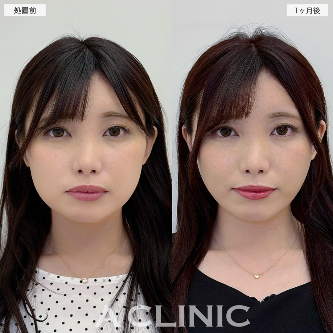 1day小顔脂肪吸引は経過とともに可愛さアップします！こちら処置前と1ヶ月後の症例です(30代女性)